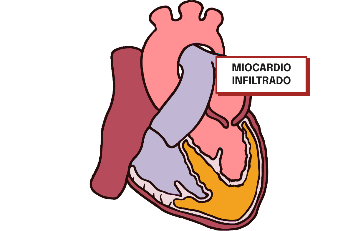Miocardio infiltrado